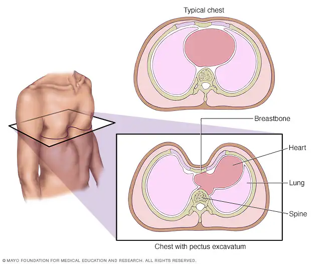 Ilustración médica que muestra la condición de pectus excavatum o pecho hundido, para la cual una familia cubana pide ayuda.