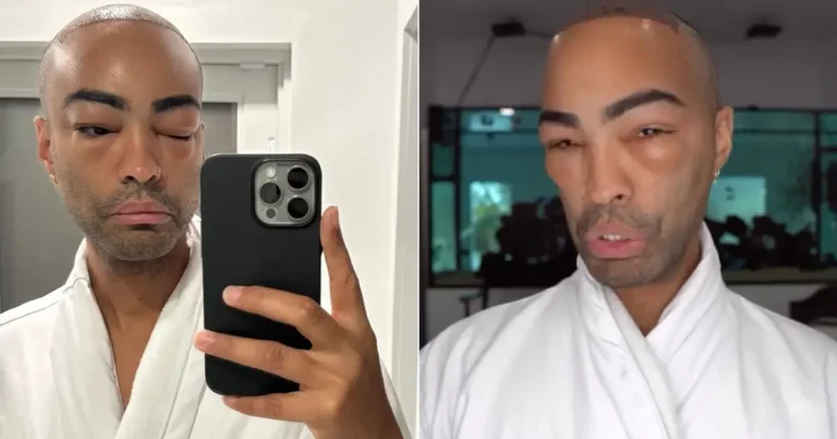 Influencer Pollito Tropical comparte experiencia tras cirugía de restauración capilar